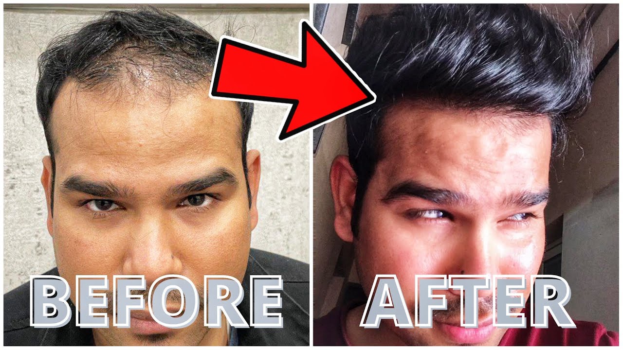 8 Months Hair Transplant Result | Density Hair Transplant Center Ranchi & Patna | Dr. Santosh Modi