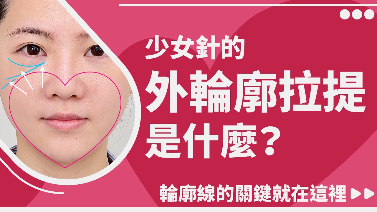 【網友愛問】少女針的外輪廓拉提是什麼？為什麼這麼受歡迎？什麼人最適合打？輪廓線的關鍵就在這裡！