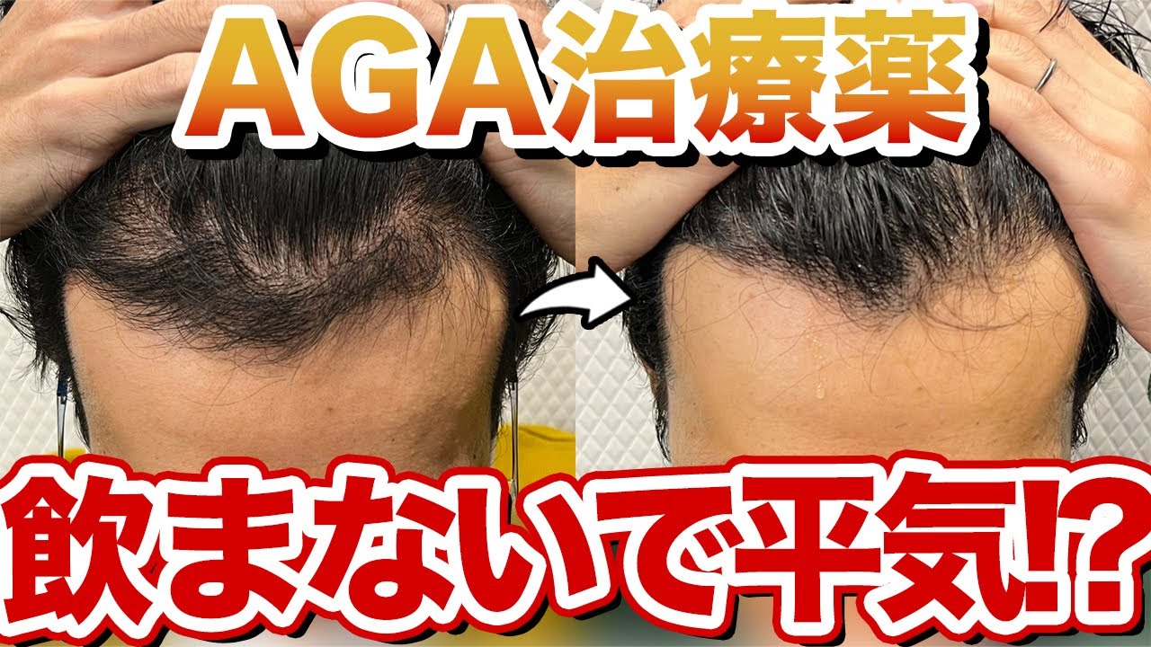 【植毛６ヶ月】AGA治療薬を服用しないとどうなる？【ミノタブ・フィナステリド】