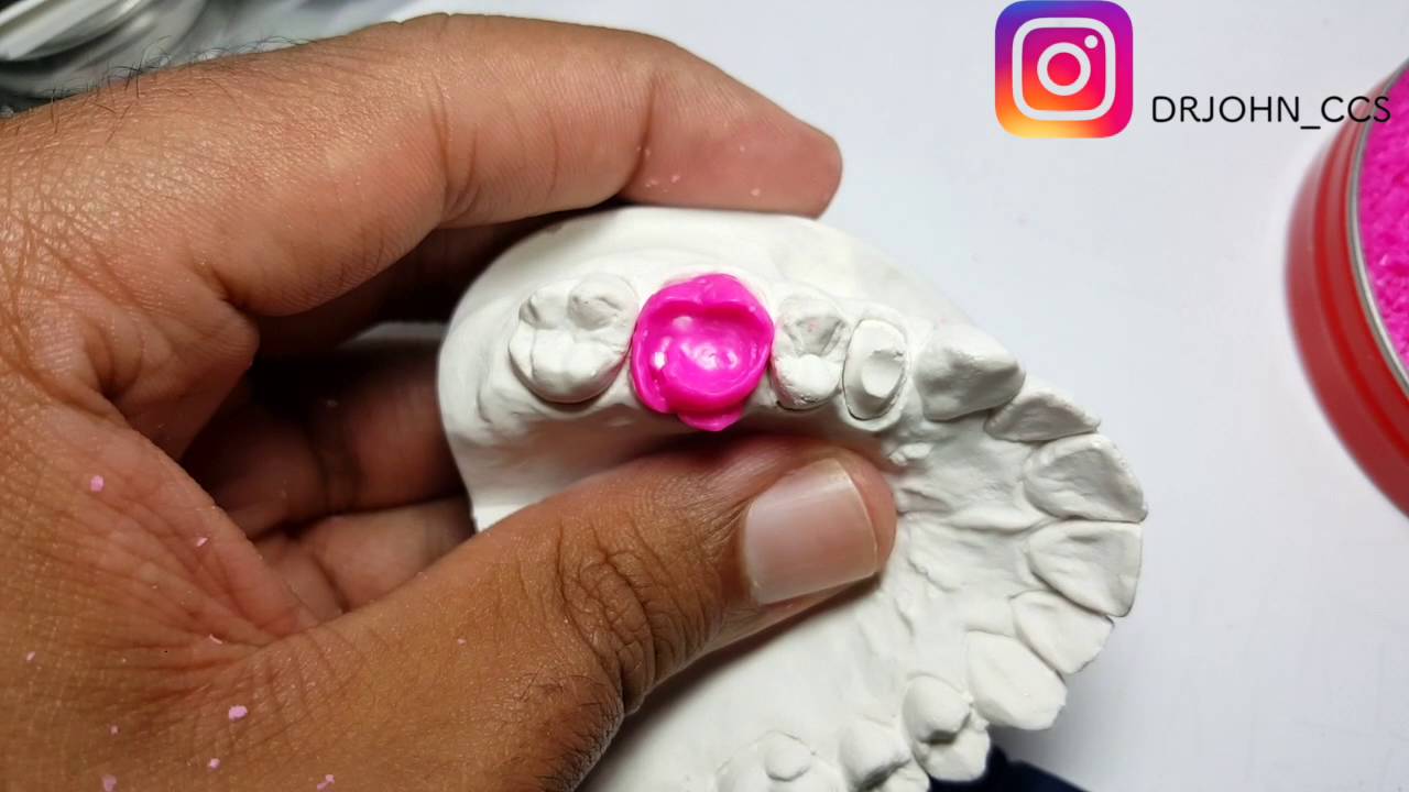 WaxUp Tutorial. Primer Molar Superior Permanente. Por John Monges Bonacia.  DEMO