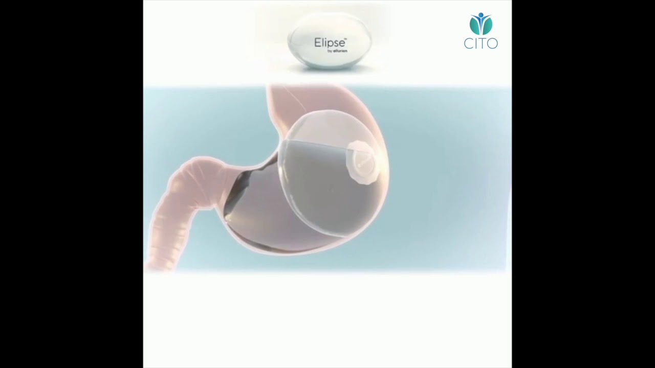 Bal&oacute;n g&aacute;strico Elipse