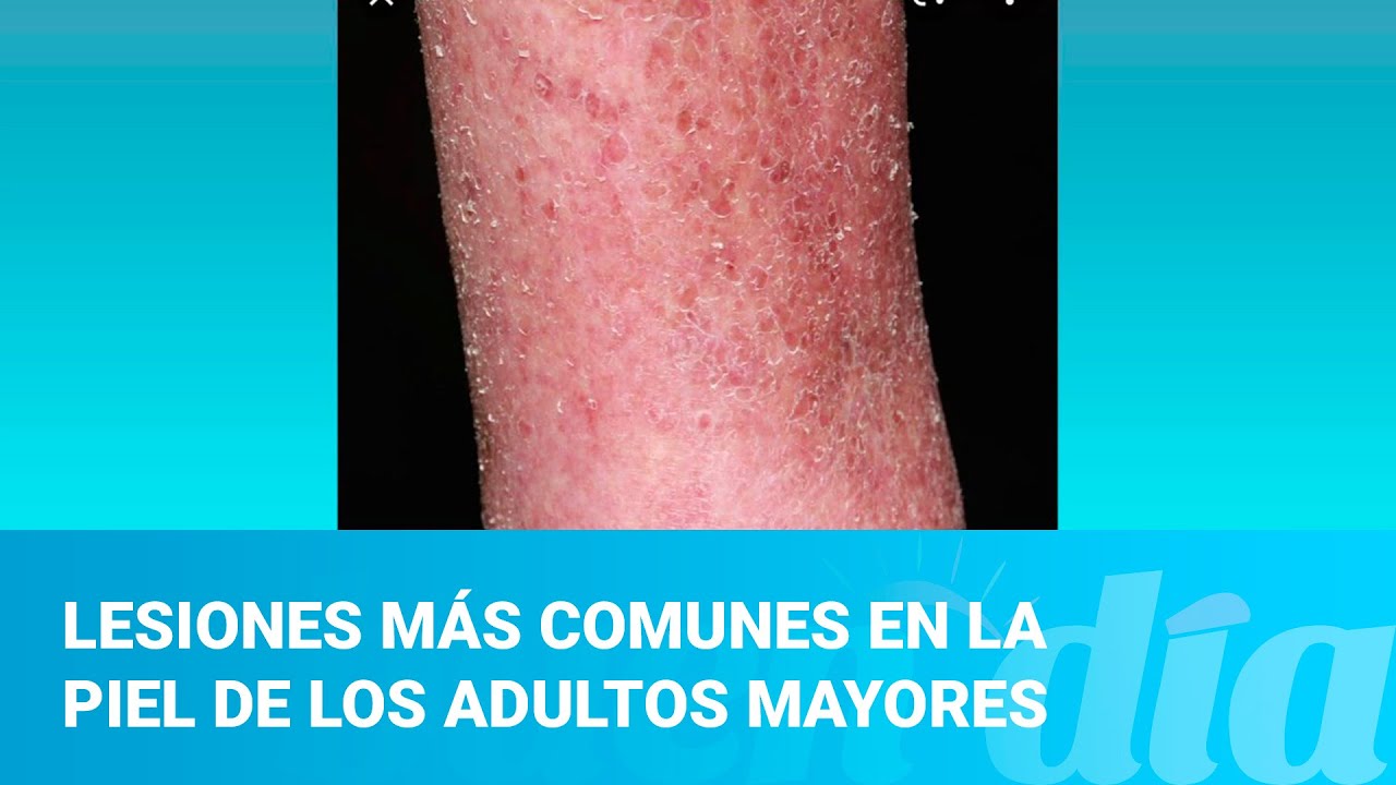 Lesiones más comunes en la piel de los adultos mayores