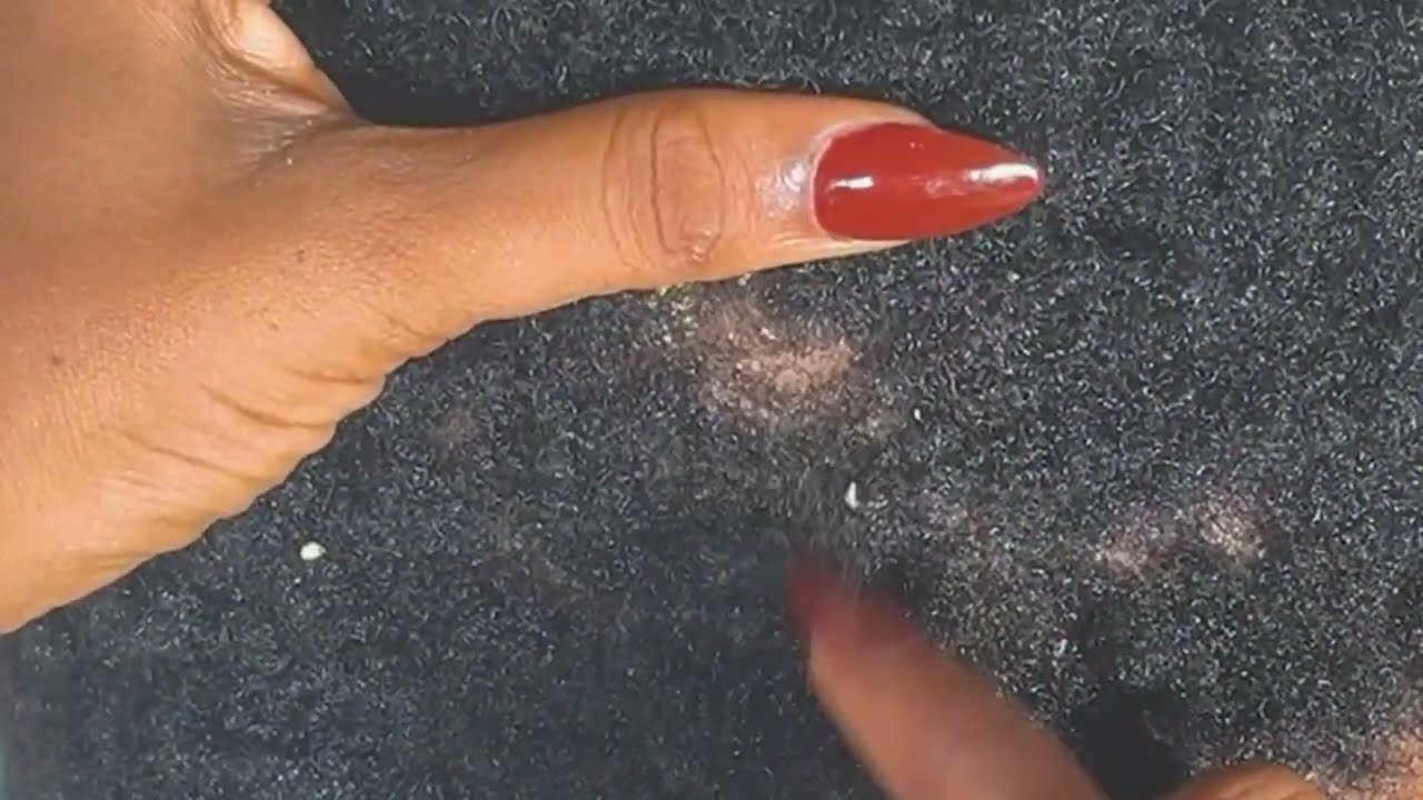 ASMR FOR SLEEP✨GUM CRACKING, SCALP SCRATCHING, SCRATCHING SOUND 