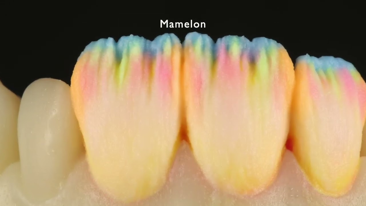 IPS e-max Stratification -micro stratification / montage céramique dentaire (OUAZENE Sofiane)