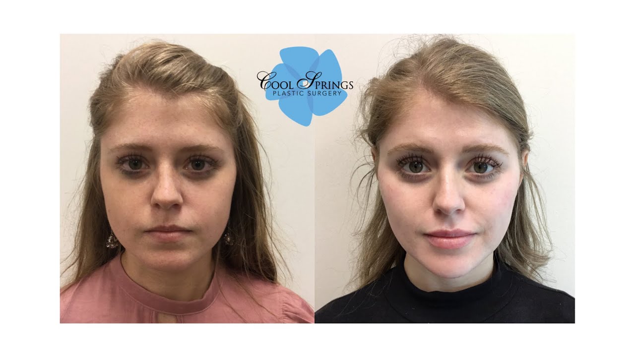 Facial Slimming *FINAL RESULT* | Patient Journey Part 5 | Nashville Injector