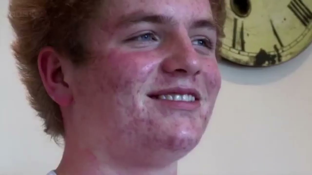 William's Acne Story