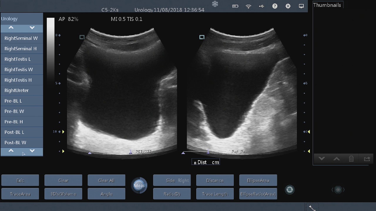 How to Measure Bladder Volume with Ultrasound on the QSONO D8 Wireless Ultrasound