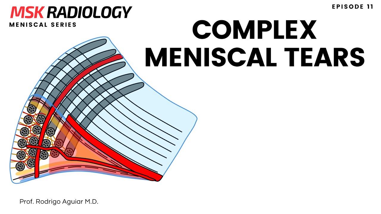 Complex Meniscal Tear on MRI