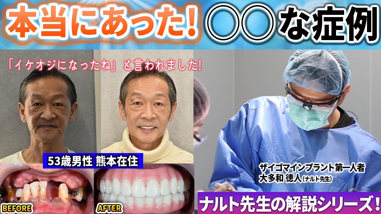歯も歯茎も骨もないインプラントも無理…そんな患者をナルト先生がザイゴマインプラントで1日で治したら…なんとイケオジになった！本当にあったシリーズ！