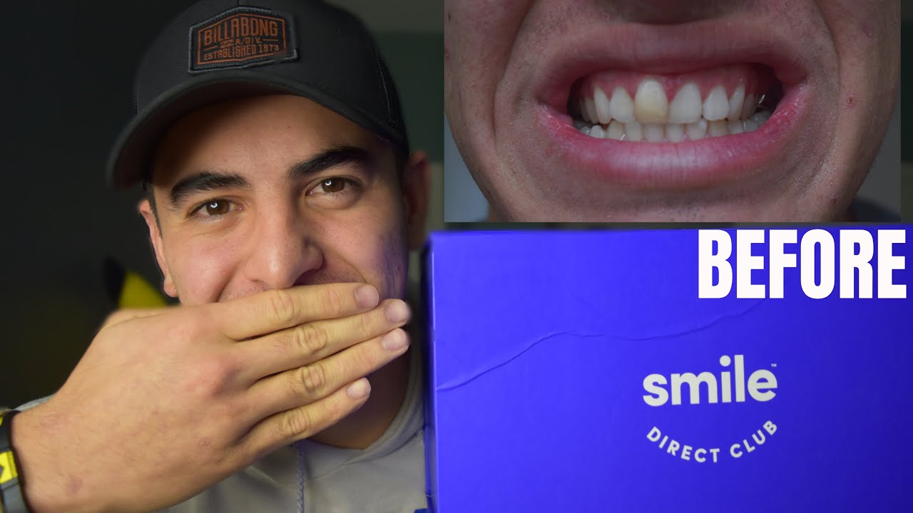 I TRIED SMILE DIRECT CLUB FOR 6 MONTHS! (And This is What Happened)