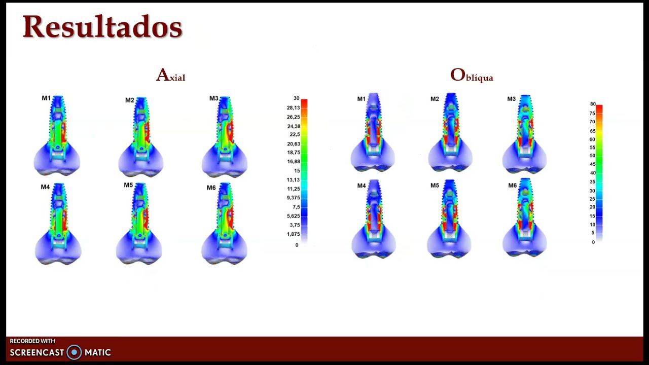 UFJF/ SEMIC 2021-Efeito da osteoporose e perda &oacute;ssea vertical em implantes osseointegrados em maxila