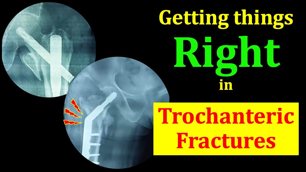 Getting Things Right in Trochanteric Fractures