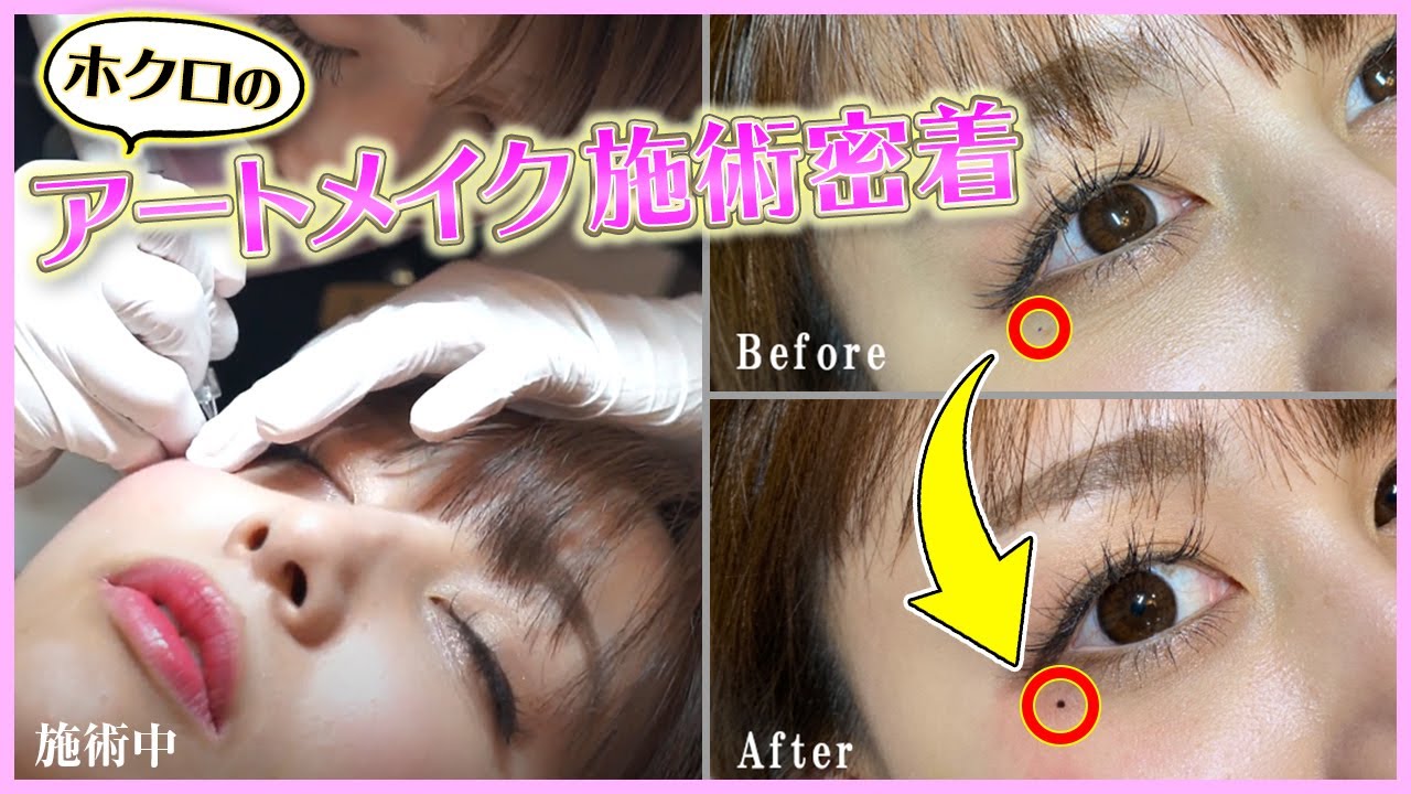 【アートメイク施術密着】目元に"ほくろ"を入れて大人っぽいイメージに！Before & After