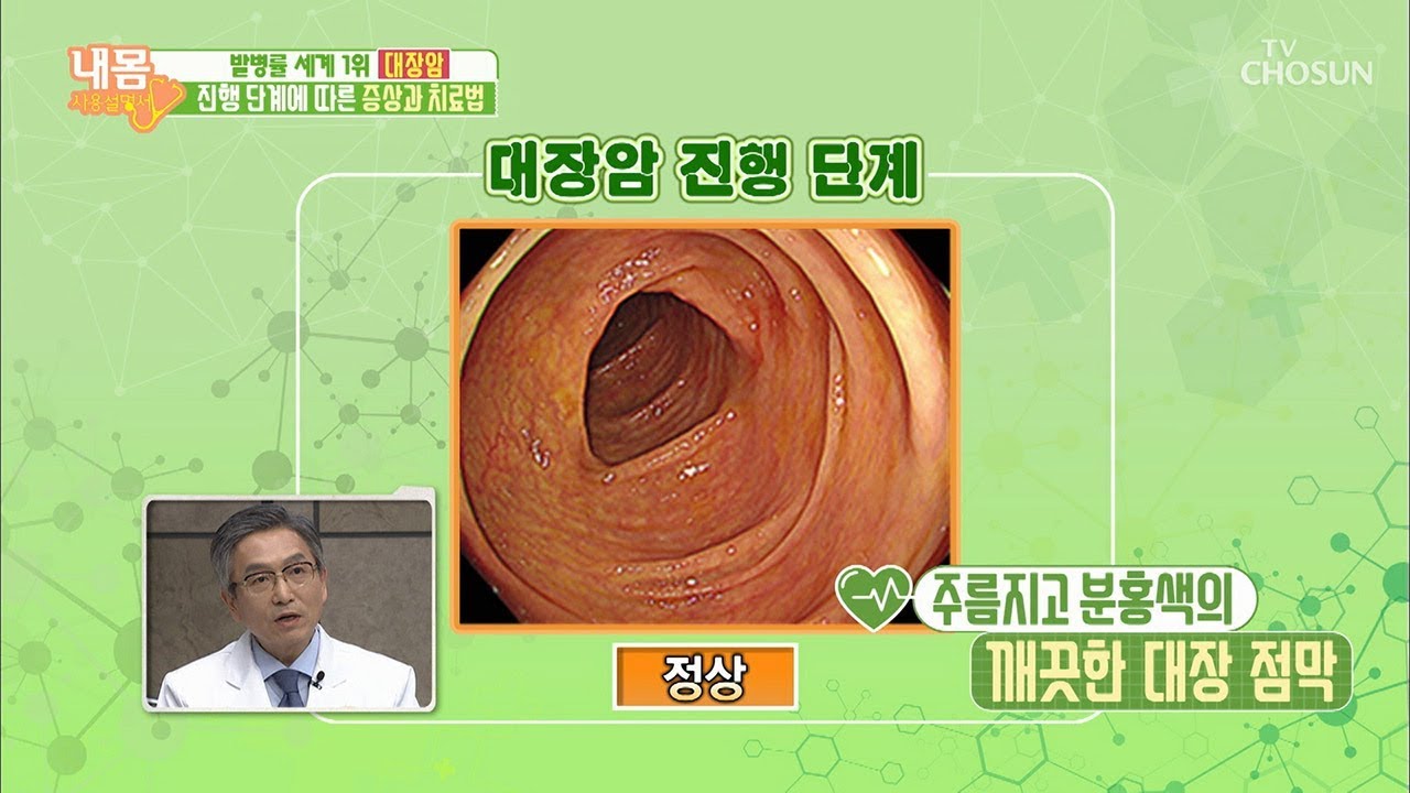 소리 없이 찾아오는 대장암! 단계별 모습은? [내 몸 사용설명서] 232회 20181221