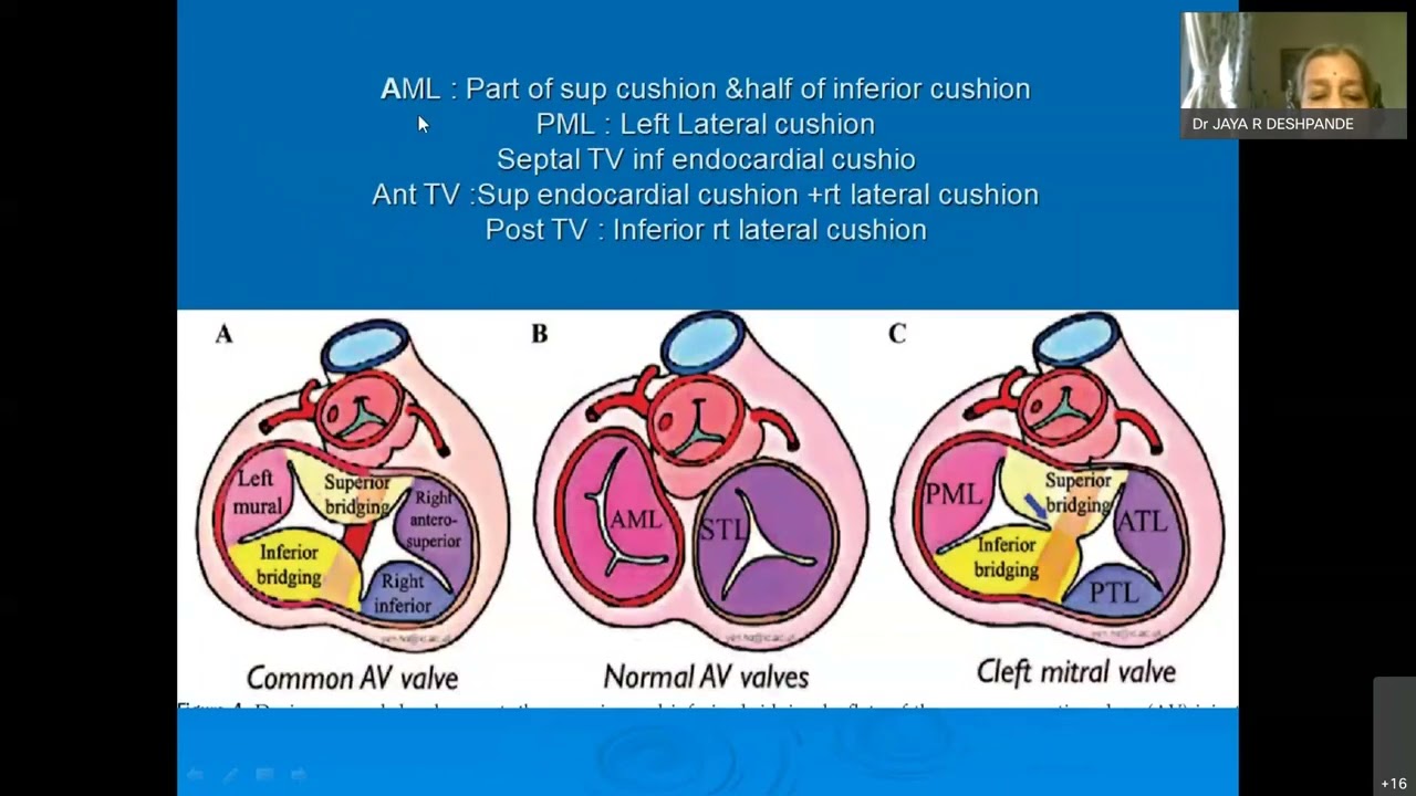 AV Canal Defects of CHD #7 by Dr. Jaya Deshpande