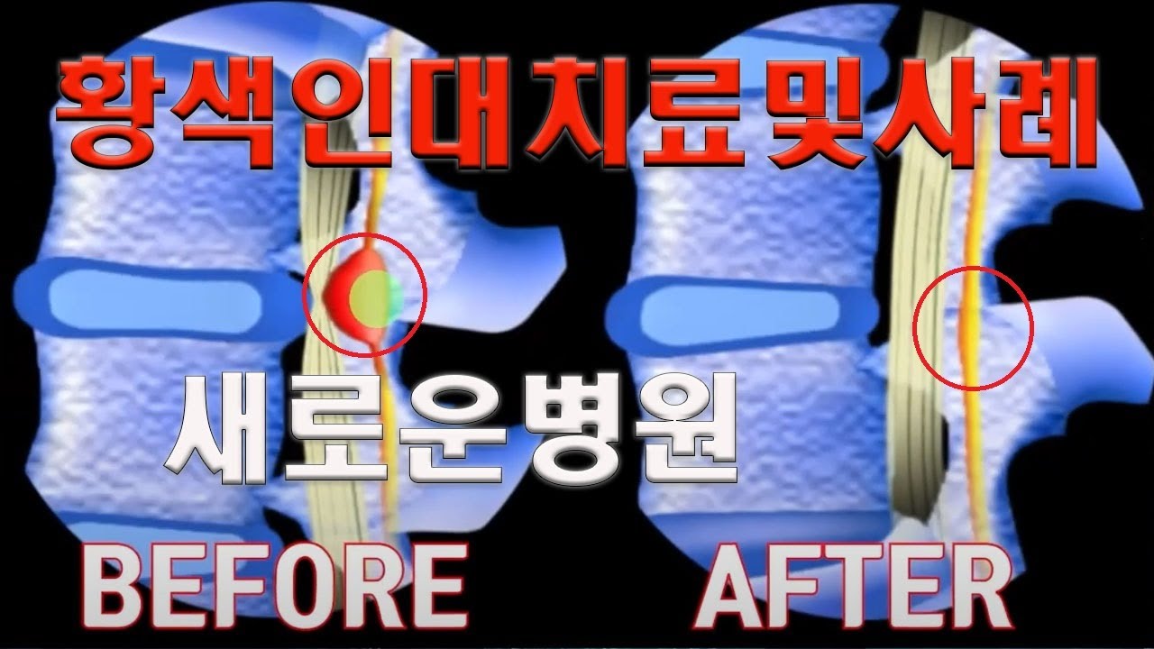척추 수술적치료 황색인대 치료 및 사례