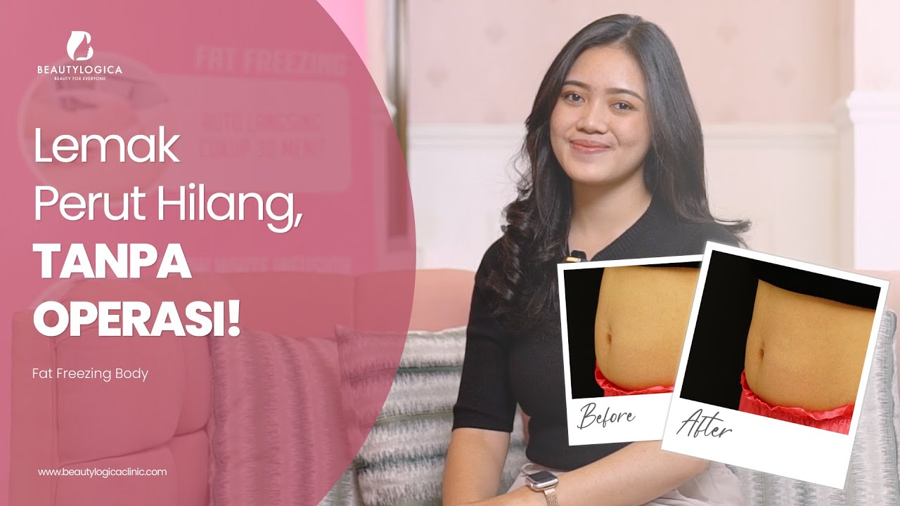 PERUT BUNCIT HILANG, TANPA OPERASI! INTIP PROSESNYA✨#fatfreezing