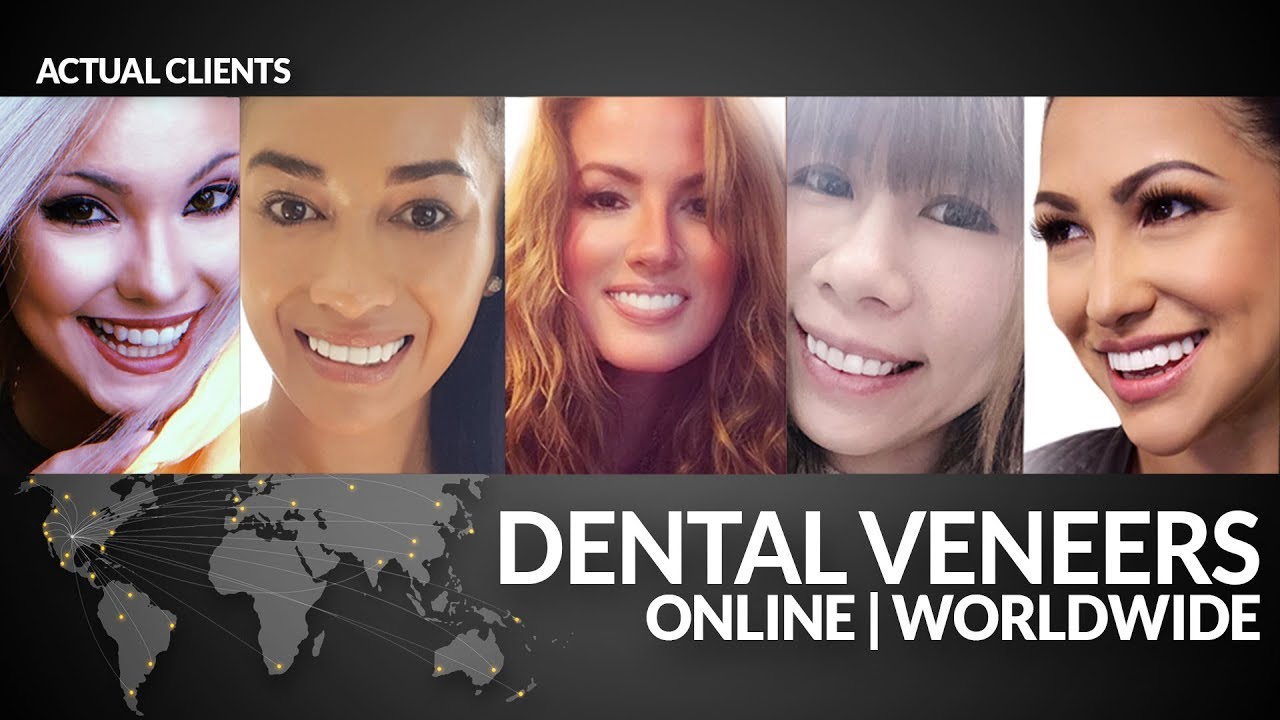 Dental Veneers -Smile Makeover -No Cosmetic Dentist -World Wide by Brighter Image Lab!
