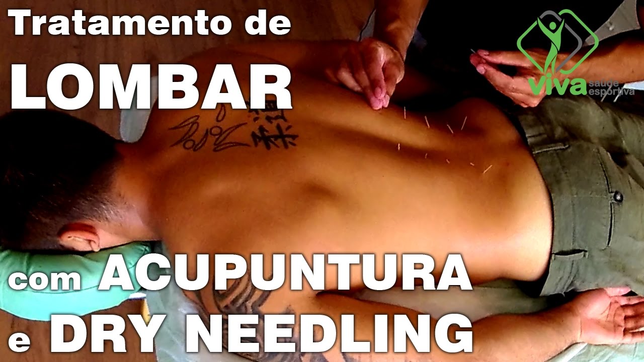 TRATAMENTO DE LOMBAR com ACUPUNTURA e DRY NEEDLING
