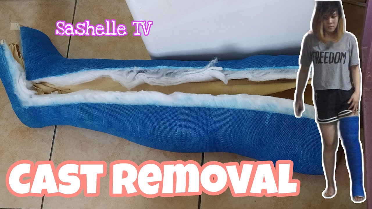 Cast Removal | Semento sa Tuhod | Left Knee