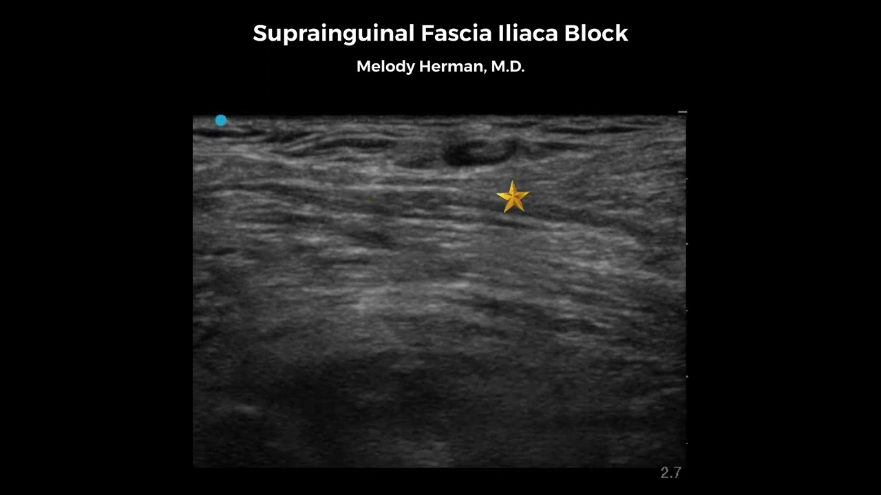 Suprainguinal Fascia Iliaca Block