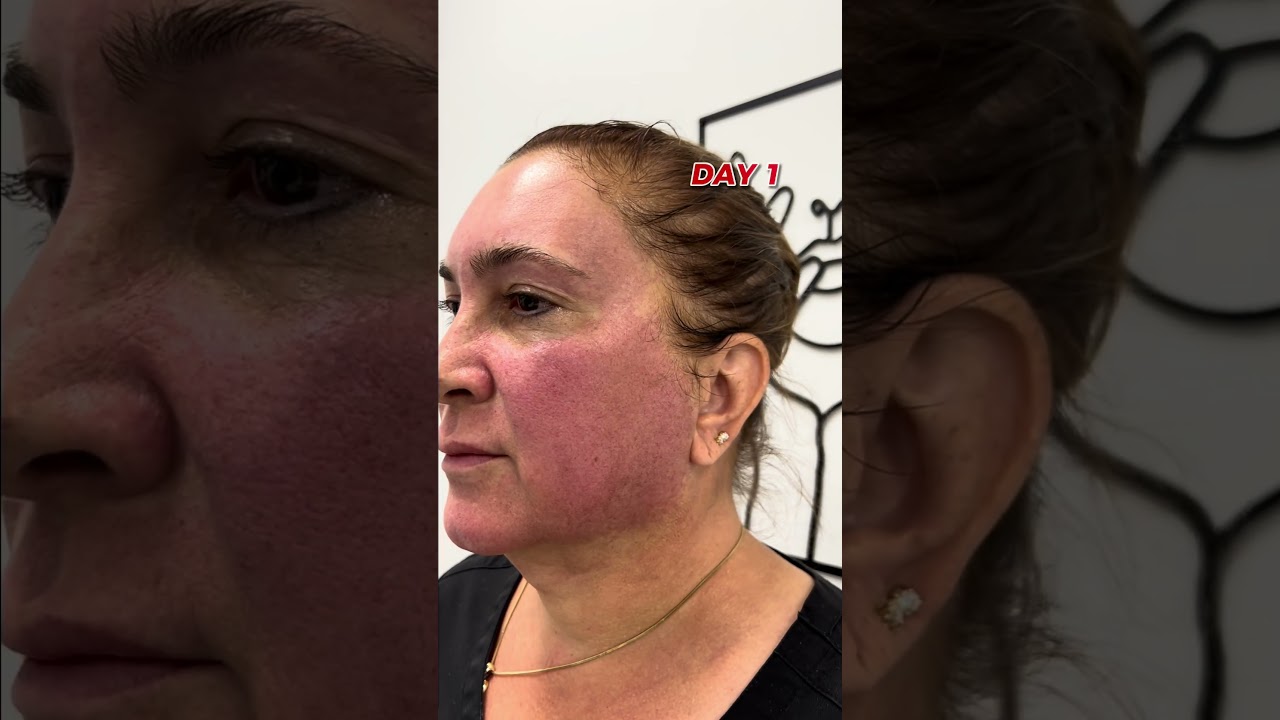 What to expect after your HALO laser treatment