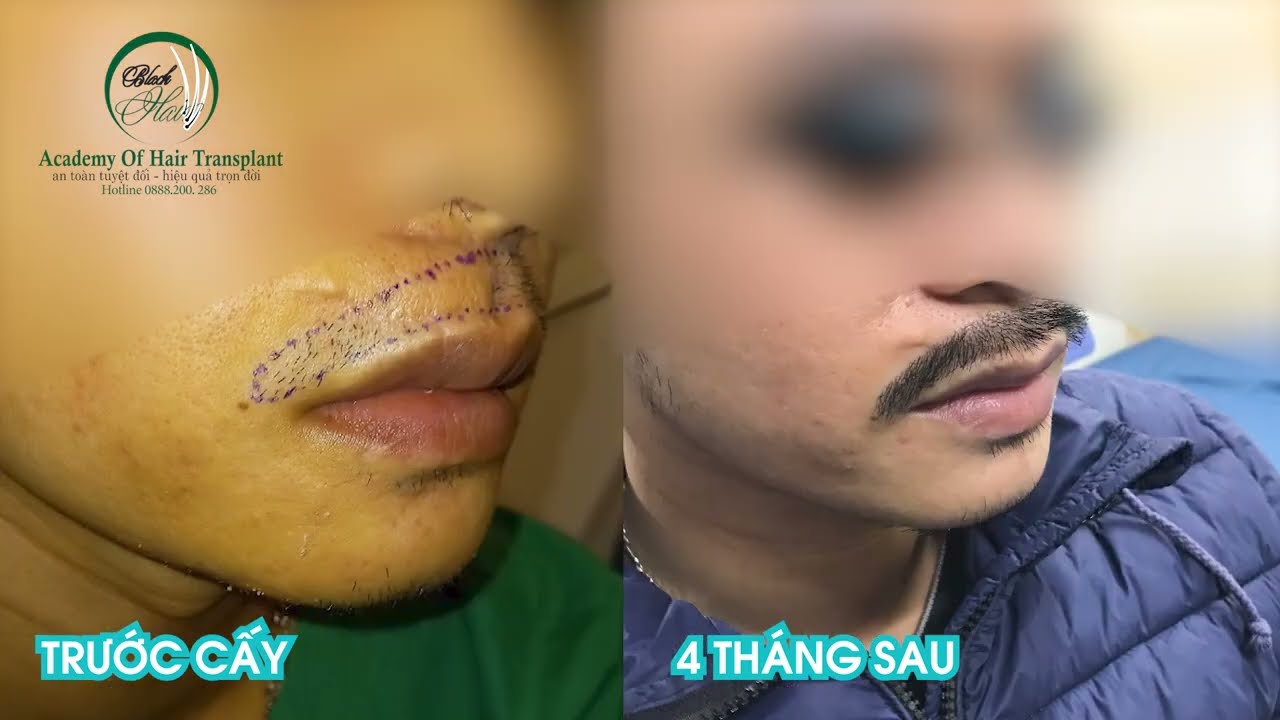 Cấy râu kĩ thuật khó và nhiều thách thức.