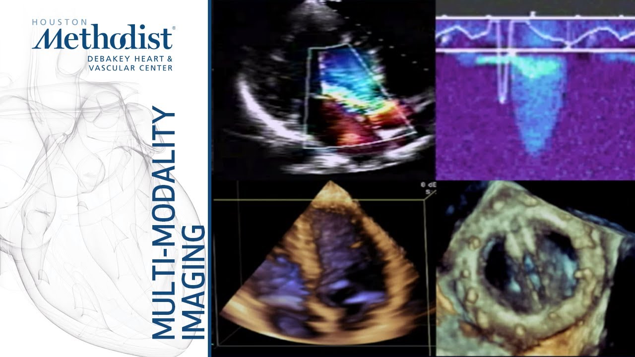 Basic Principles of Echocardiography and Doppler (William A. Zoghbi, MD) September 8, 2020