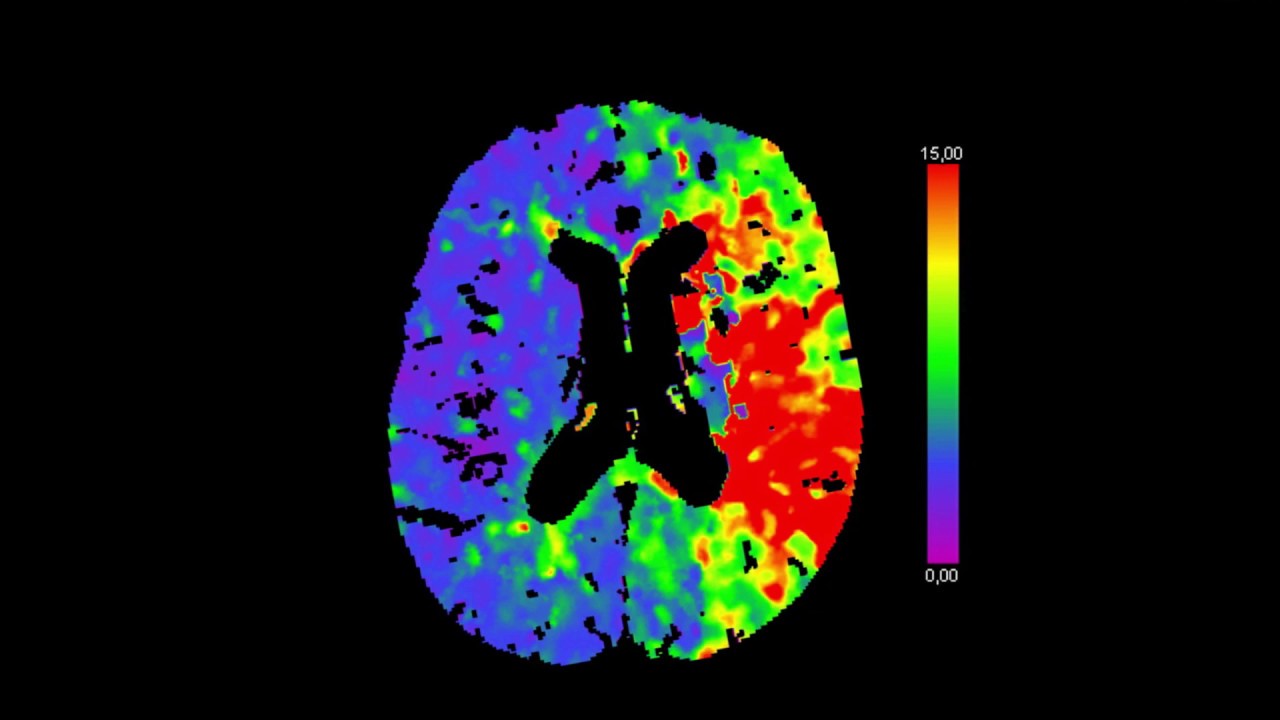 Herseninfarct: acute behandelingen