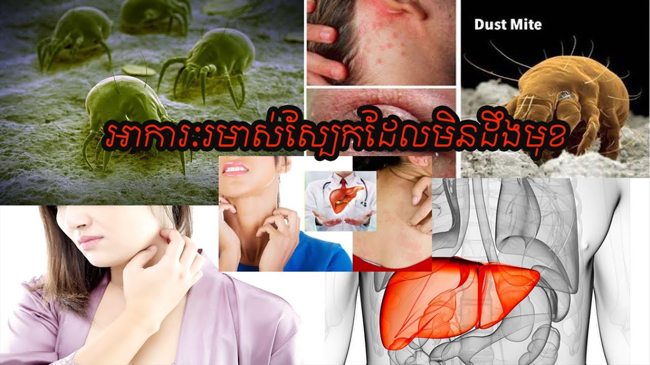 មូលហេតុកើតរមាស់ស្បែក ដែលមិនដឹងមុខ