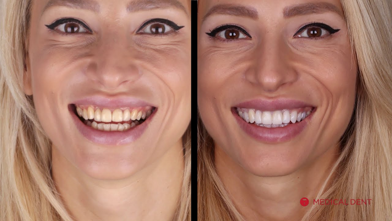 Smile Design - Поставяне на фасети от д-р Бранимир Кирилов | Medical Dent