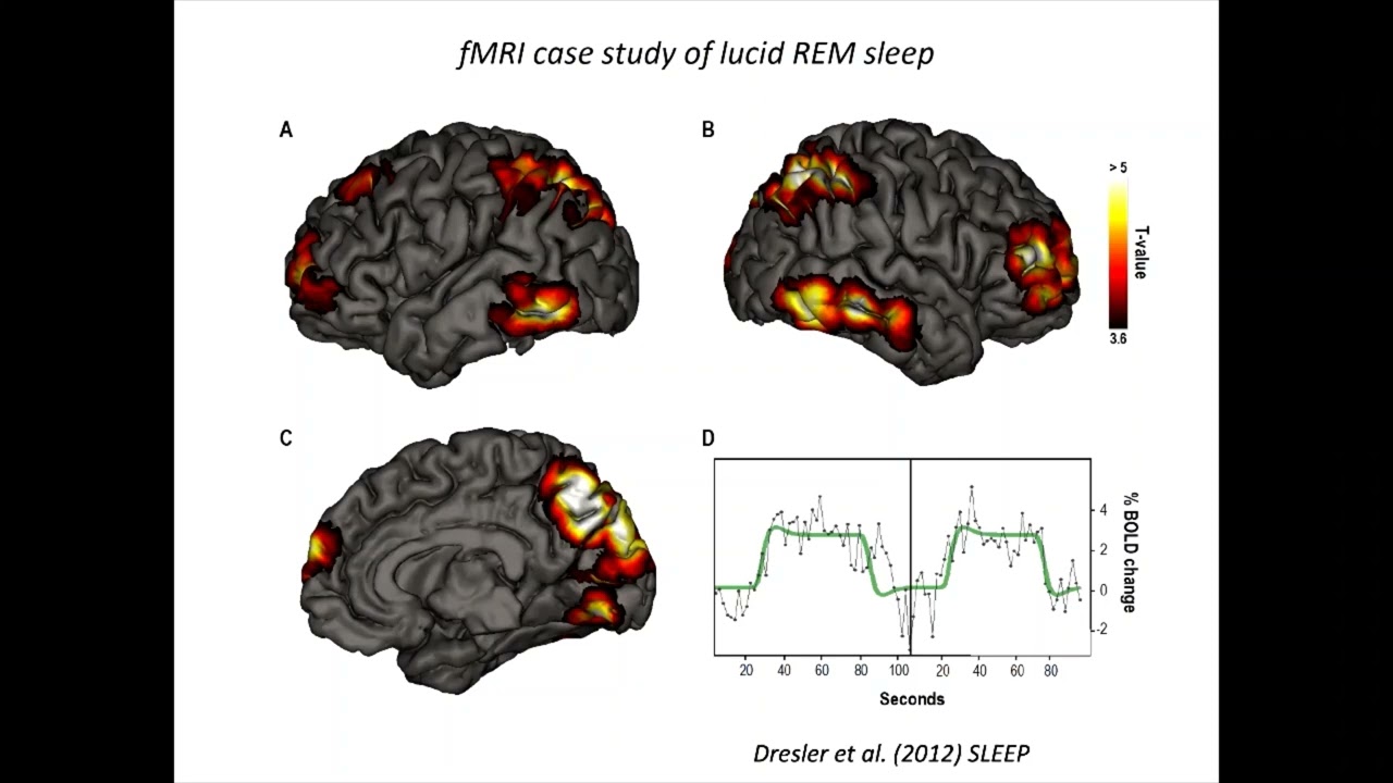 Recent findings in the Cognitive Neuroscience of Lucid Dreaming