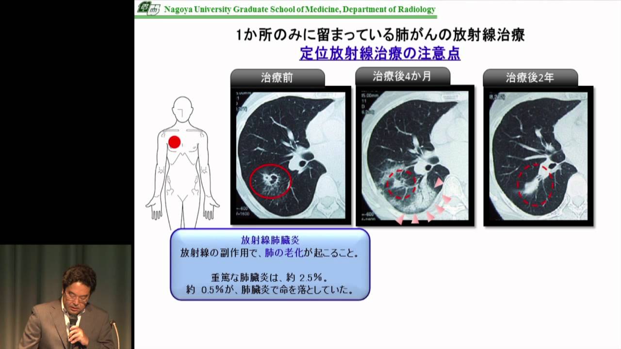 肺がんの放射線治療　岡田　徹