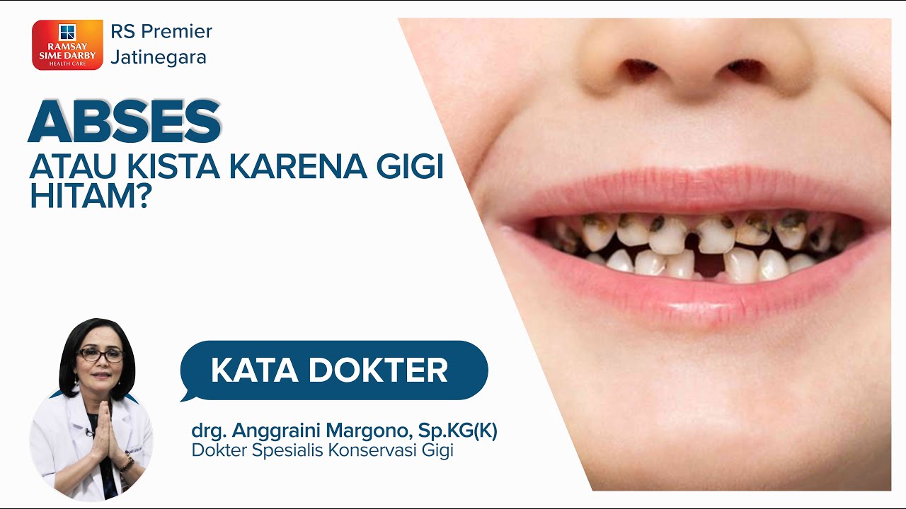 GIGI HITAM JANGAN DIABAIKAN - KATA DOKTER ANGGRAINI