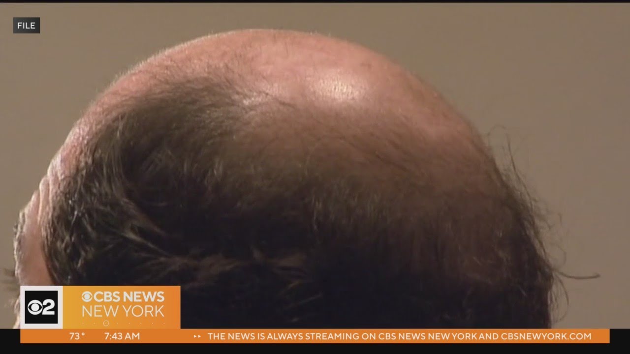 On Call with Dr. Kumar: Tips on how to prevent hair loss