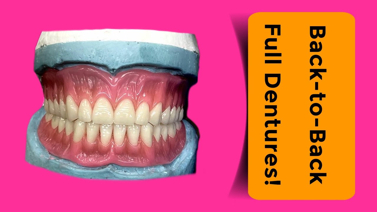 Full Denture Wax-Up Marathon!