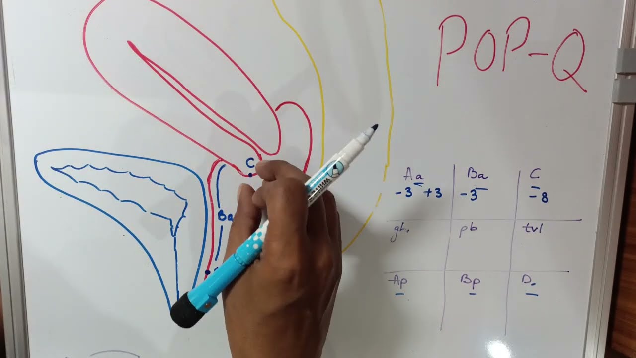 POP-Q (пролапс тазовых органов - количественная оценка)@Love_Obs_Gynae