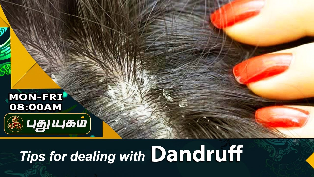 How to Get Rid of Dandruff  | Morning Cafe | 20/07/2017 | Puthuyugam TV