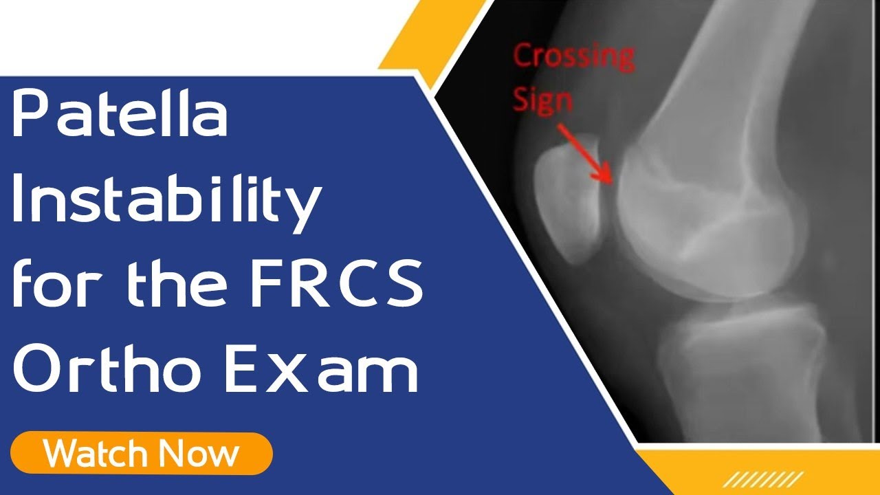 Patella Instability for the FRCS Ortho Exam | Orthopaedic Academy