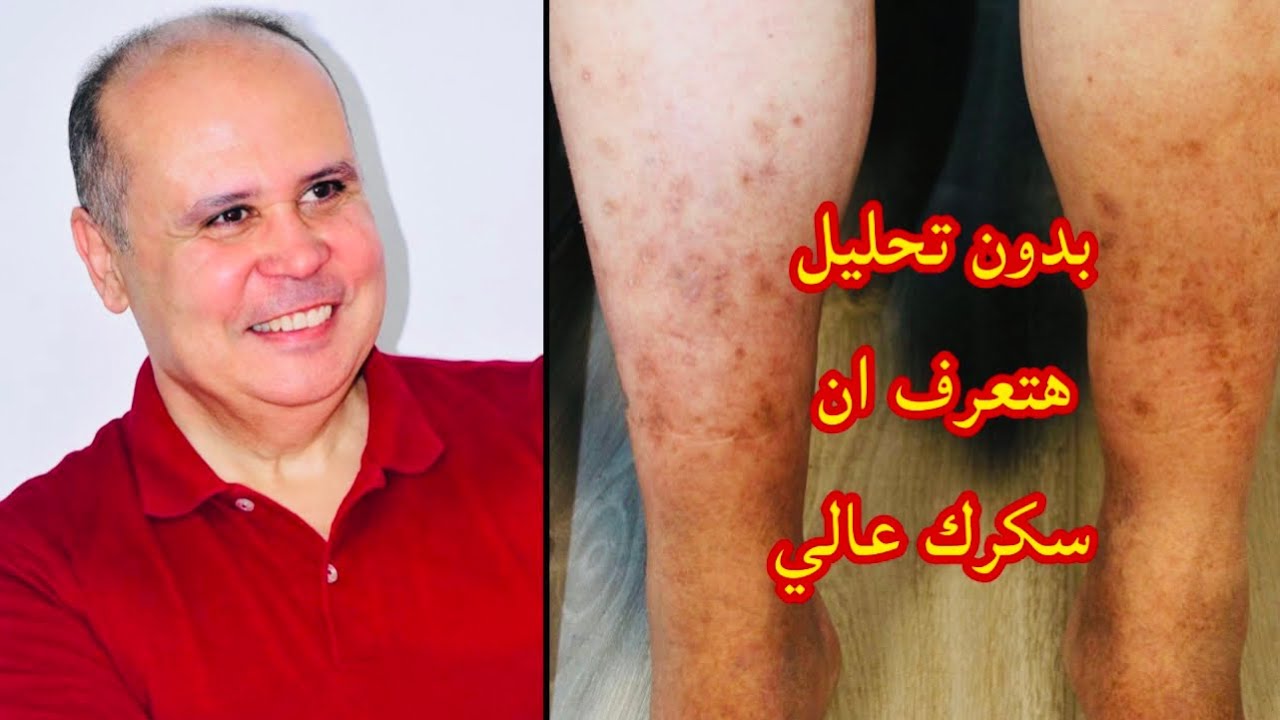 بدون تحليل من جسمك وجلدك هتعرف ان  السكر عالي جدا في الدم 👈وارتفاع التراكمي