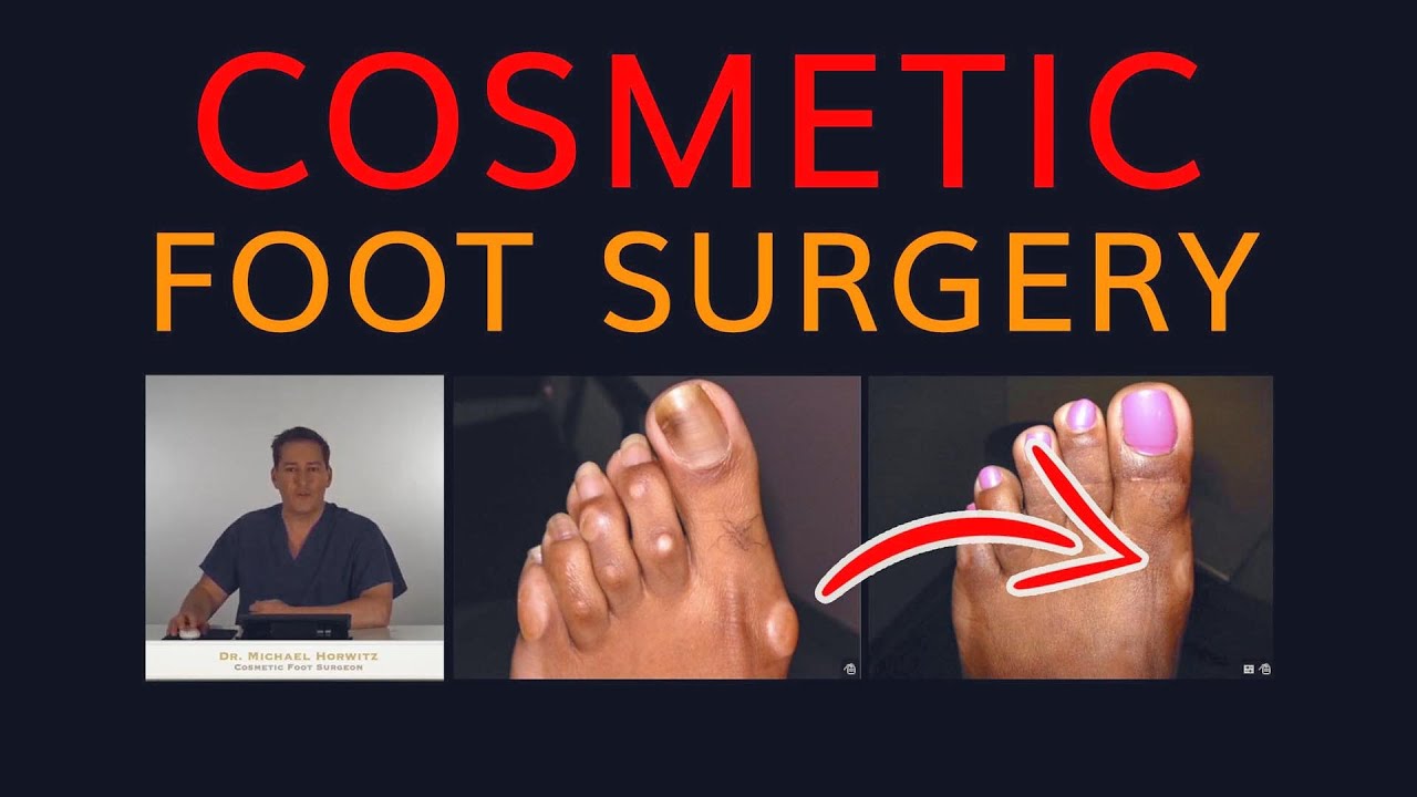 Cosmetic Foot Surgery - Super Transformation! Dr. Horwitz - Feet For Life Channel