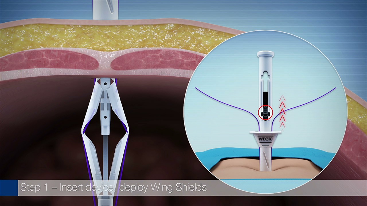 Weck&reg; EFx Shield&reg; Fascial Closure System - Overview Animation