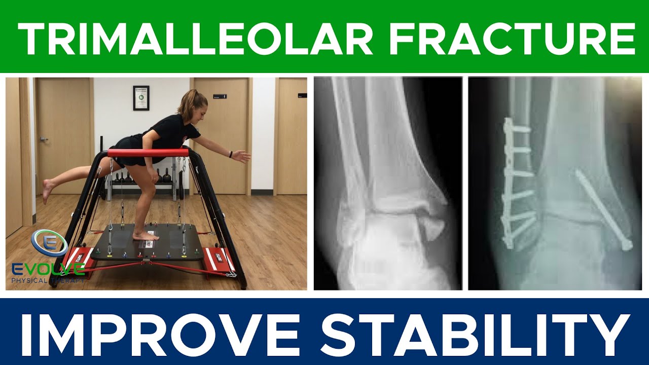Trimalleolar Fracture | Improving Dynamic Ankle Stability  | Part 2