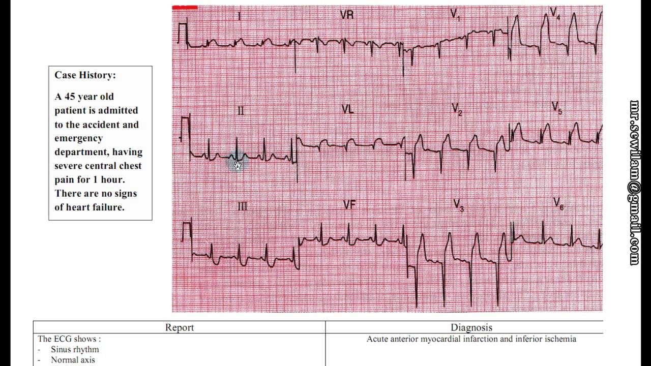 شرح ECG د.محمود سويلم
