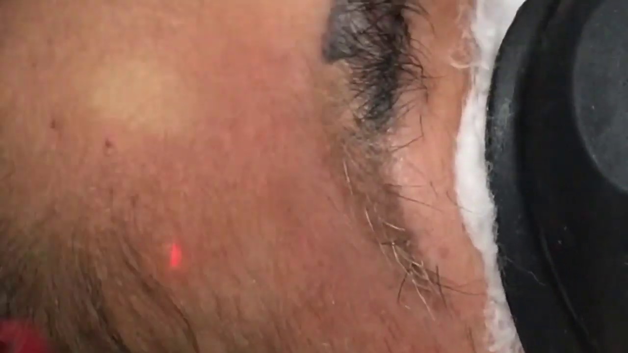 Despigmentação de sobrancelha a laser