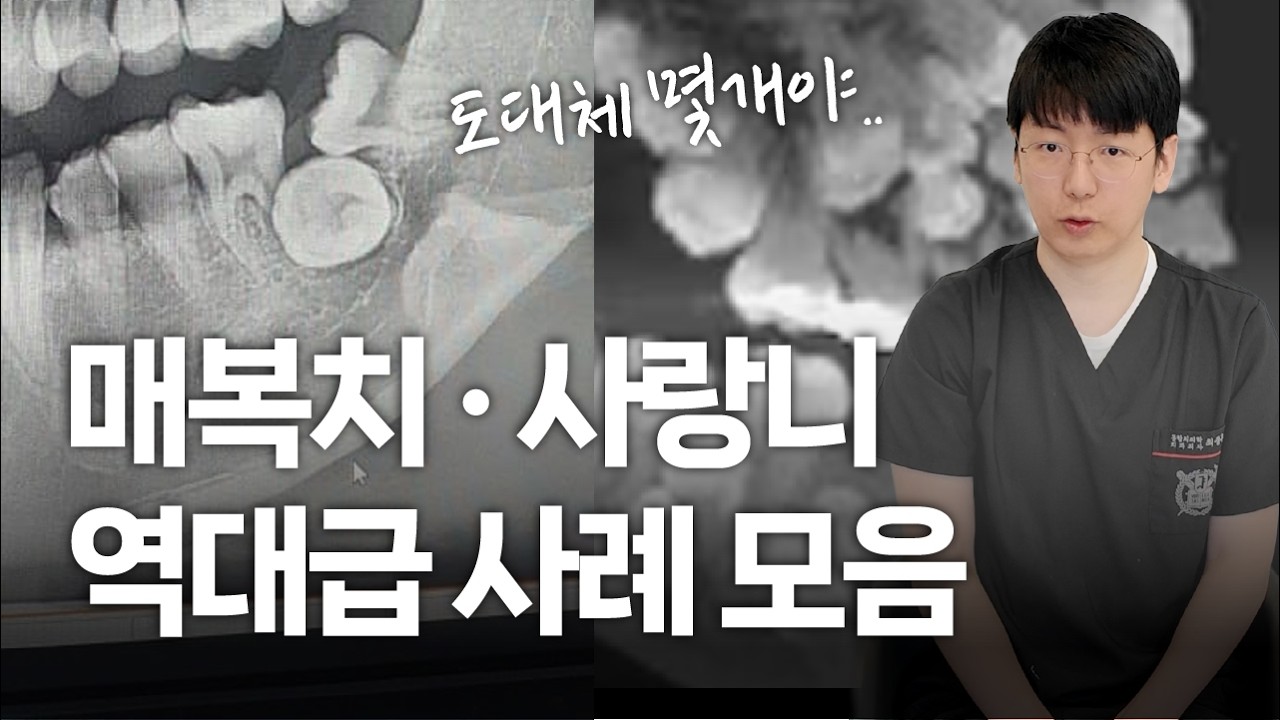 매복치 · 사랑니 역대급 사례 모음 10