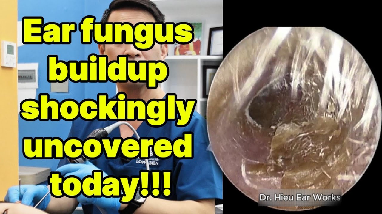 Ear fungus buildup shockingly uncovered today | ear cleaning | ASMR earwax | soothing |relax|