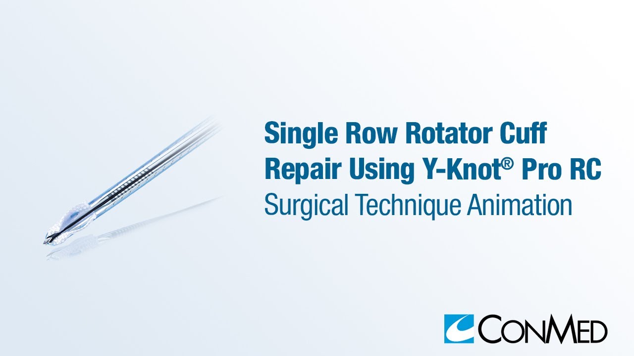 Single Row Rotator Cuff Repair Using Y-Knot® PRO RC - CONMED Animation