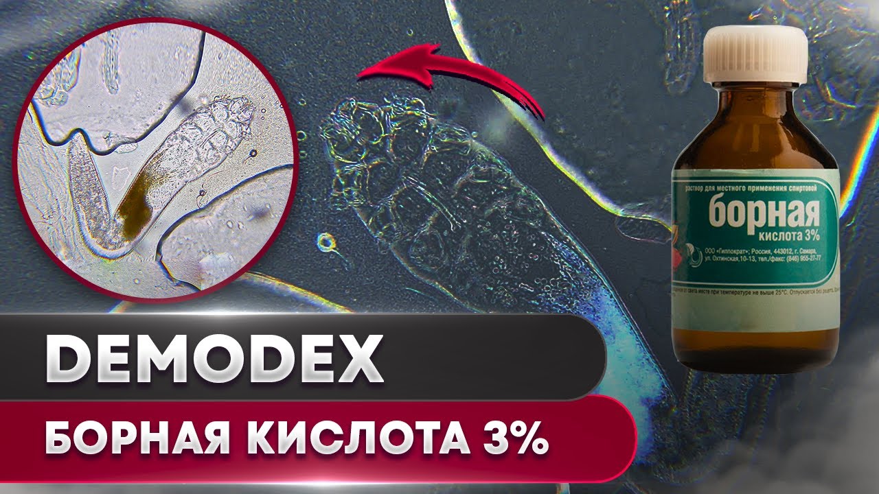 Борная Кислота 3% против клеща | Угревая Железница Demodex