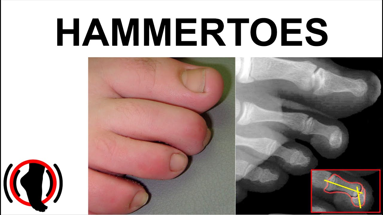 Hammertoes - Types - Flexor Stabilization, Flexor/Extensor Substitution - Origins - Etiology